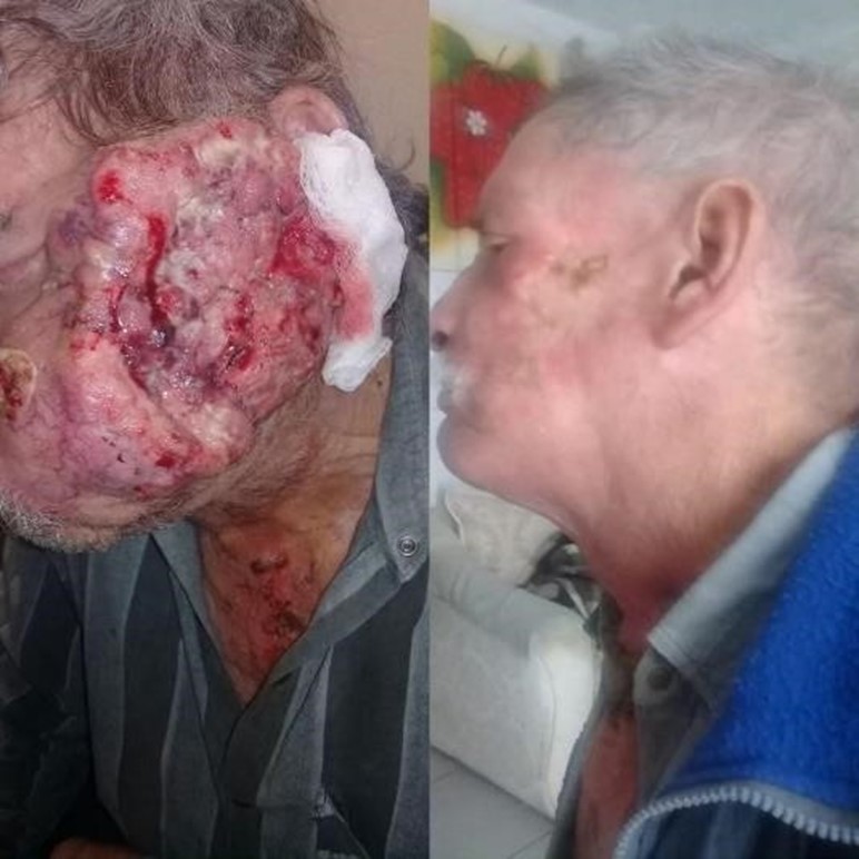 Cancer on face