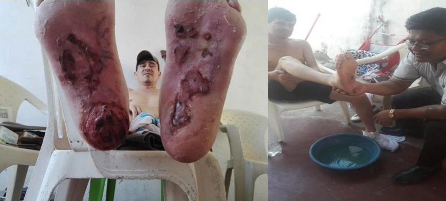 Gangrene 2