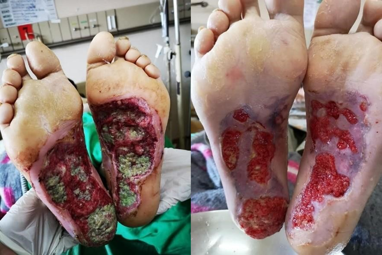 Gangrene