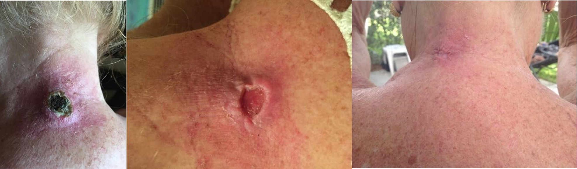 Melanoma